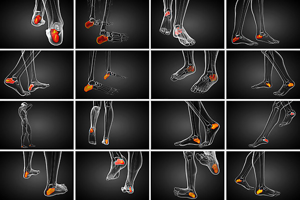 포토 JPG 해외이미지 뼈 골격 건강 사람 사람없음 3D 고통 환자 발목 양발 정형외과 해외202004 해외포토 감정 의학 발 병원 디지털합성 파일형식