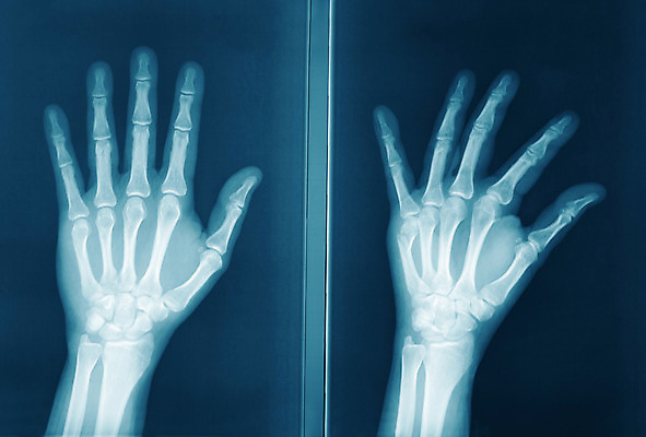 포토 JPG 해외이미지 손 과학 컨셉 부분 손가락 해부 뼈 골격 엑스레이 건강 병원 사람 사람없음 약 고통 광선 손목 라디오 팔 외과 골절 깨짐 돌봄 방사선 오리지널 해외202004 해외포토 감정 의학 모션 신체부위 전자제품 파일형식