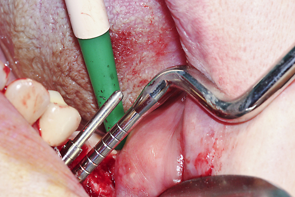 포토 JPG 해외이미지 직업 건강 치과 사람 성인 사람없음 치료 약 환자 의사 흰색 오픈 입 수술 치아 치과의사 외과 돌봄 해외202008 해외포토 컬러 의학 모션 병원 신체부위 의료진 소화기관 파일형식