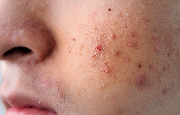 포토 JPG 해외이미지 라이프스타일 남자 얼굴 백그라운드 건강 사람 동양인 소년 사람없음 치료 10대 약 화장품 흰색 미용사 피부 순수 문제 턱 고립 돌봄 사춘기 위생관리 해외202008 해외포토 직업 어린이 컬러 컨셉 의학 모션 청소년 관리 인종 생활 신체부위 뷰티 파일형식