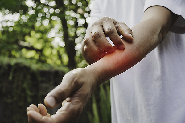 포토 JPG 해외이미지 손 남자 어린이 신체 건조 건강 사람 소년 성인 사람없음 약 고통 질병 손목 피부 문제 팔 토막 알레르기 돌봄 증상 해외202008 해외포토 감정 의학 모션 신체부위 파일형식