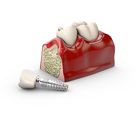 포토 JPG 해외이미지 모델 일러스트 왕관 뼈 건강 치과 병원 사람 사람없음 치료 약 금속 장비 흰색 입 구멍 실험실 치아 치과의사 만들기 뿌리 외과 턱 틀니 고립 돌봄 보철 인공 잇몸 철강 치아교정 해외202008 해외포토 컬러 신체 의학 모션 재질 실험 신체부위 의사 소화기관 교정 파일형식