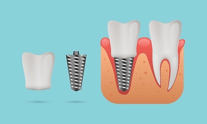 EPS 해외이미지 모델 디자인 백그라운드 일러스트 왕관 뼈 건강 치과 병원 사람 치료 약 금속 흰색 나사 입 구멍 치아 치과의사 뿌리 턱 틀니 돌봄 보철 인공 철강 치아교정 현실 해외202008 해외일러스트 컬러 의학 모션 재질 신체부위 의사 공구 소화기관 교정 파일형식 벡터