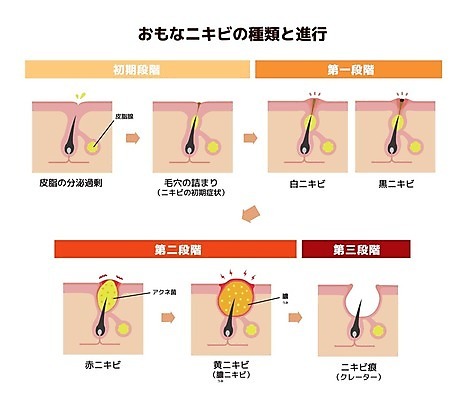 EPS 해외이미지 디자인 신체 일러스트 해부 세포 건강 사람 치료 흰색 질병 피부 생물학 분화구 문제 층 박테리아 끓이기 돌봄 해외202008 해외일러스트 교육 컬러 의학 모션 신체부위 화산 파일형식 벡터 산