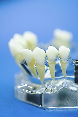 포토 JPG 실내 치과 근접촬영 사람없음 아웃포커스 모형 의료용품 치아 치과용품 치아모형 임플란트 티타늄 국내포토 뷰포인트 의료기기 촬영기법 병원 내부 소화기관 원소 파일형식