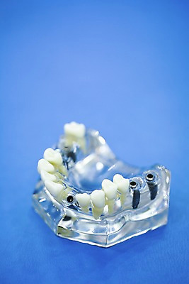 포토 JPG 실내 치과 사람없음 아웃포커스 모형 의료용품 치아 치과용품 치아모형 임플란트 티타늄 국내포토 의료기기 촬영기법 병원 내부 소화기관 원소 파일형식