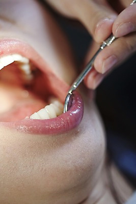 포토 JPG 손 의학 실내 치과 병원 입벌림 사람 동양인 근접촬영 신체부위 치료 진료 거울 환자 의료용품 입 치아 입술 치과용품 치과진료 구강거울 국내포토 뷰포인트 의료기기 표정 인종 내부 소화기관 파일형식