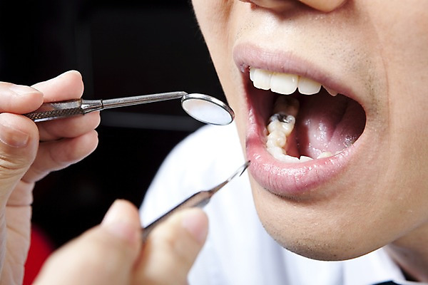 포토 JPG 손 의학 실내 치과 병원 입벌림 사람 동양인 손짓 근접촬영 신체부위 치료 진료 거울 환자 의료용품 입 치아 입술 치과용품 치과진료 치석제거기 구강거울 국내포토 뷰포인트 의료기기 모션 표정 인종 내부 소화기관 파일형식