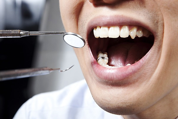 포토 JPG 의학 실내 치과 병원 입벌림 사람 동양인 근접촬영 신체부위 치료 진료 거울 환자 의료용품 입 치아 입술 치과용품 치과진료 치석제거기 구강거울 국내포토 뷰포인트 의료기기 표정 인종 내부 소화기관 파일형식