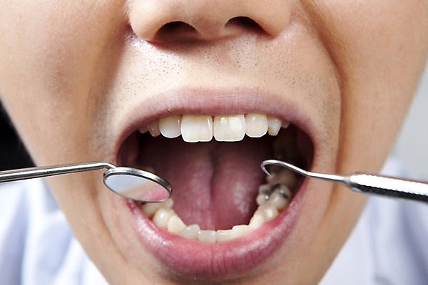 포토 JPG 의학 실내 치과 병원 입벌림 사람 동양인 근접촬영 신체부위 치료 진료 거울 환자 의료용품 입 치아 입술 치과용품 치과진료 치석제거기 구강거울 국내포토 뷰포인트 의료기기 표정 인종 내부 소화기관 파일형식