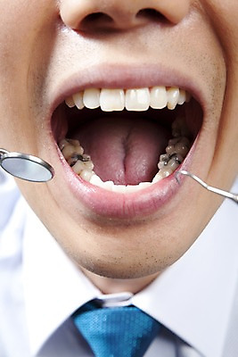 포토 JPG 의학 실내 치과 병원 입벌림 사람 동양인 근접촬영 신체부위 치료 진료 거울 환자 의료용품 입 치아 입술 치과용품 치과진료 치석제거기 구강거울 국내포토 뷰포인트 의료기기 표정 인종 내부 소화기관 파일형식