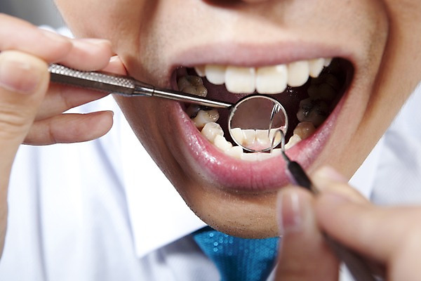 포토 JPG 손 의학 실내 치과 병원 입벌림 사람 동양인 손짓 근접촬영 신체부위 치료 반사 진료 거울 환자 의료용품 입 치아 입술 치과용품 치과진료 치석제거기 구강거울 국내포토 뷰포인트 의료기기 모션 표정 인종 내부 소화기관 파일형식