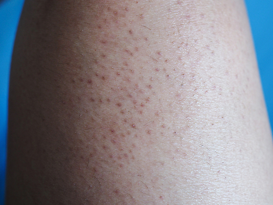 포토 JPG 해외이미지 백인 여자 백그라운드 패턴 신체 표면 추상 세포 건강 사람 성인 사람없음 약 어둠 성장 흰색 질병 큼 피부 묘사 질감 감염 암 내추럴 알레르기 곰팡이 돌봄 사춘기 위생관리 해외202009 해외포토 서양인 컬러 무늬 의학 모션 관리 신체부위 크기 파일형식