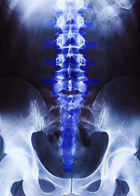 포토 JPG 해외이미지 과학 신체 해부 뼈 골격 엑스레이 건강 병원 사람 성인 사람없음 약 고통 환자 의사 광선 기둥 질병 필름 척추 몸통 외과 돌봄 방사선 해외202009 해외포토 건축 감정 의학 모션 신체부위 의료진 파일형식