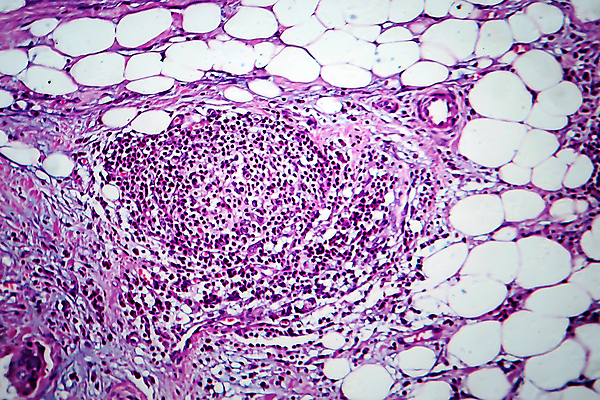 포토 JPG 해외이미지 여자 현미경 사람없음 약 얼룩 조직 확대 질병 가슴 암 해외202009 해외포토 의학 실험기구 사람 신체부위 파일형식