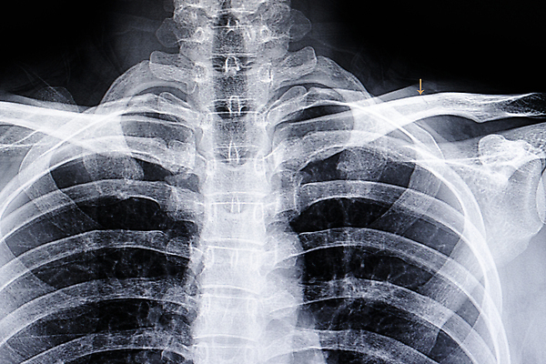 포토 JPG 해외이미지 무료이미지 백그라운드 신체 해부 뼈 골격 엑스레이 건강 병원 사람 사람없음 약 환자 의사 광선 흰색 호흡기관 질병 사건 필름 골절 궤 돌봄 해외202009 해외202105 해외포토 컬러 의학 모션 의료진 장기_의학 파일형식 무료콘텐츠