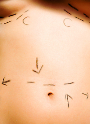 포토 JPG 해외이미지 백인 모델 여자 선 화살 병원 성인 사람없음 뷰티 활발 환자 주름 수술 엉덩이 가슴 사인 몸통 외과 복근 실리콘 의료성형뷰티 노화 셀룰라이트 해외202004 해외포토 서양인 컨셉 의학 근육 사람 신체부위 치료 파일형식