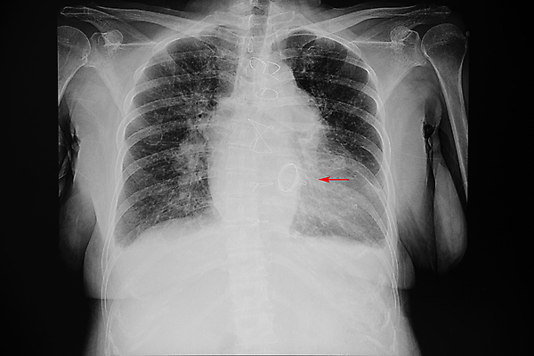 포토 JPG 해외이미지 여자 과학 백그라운드 신체 해부 뼈 골격 엑스레이 건강 병원 사람 사람없음 약 고통 환자 의사 광선 흰색 호흡기관 질병 필름 전염 교체 궤 돌봄 방사선 염증 의료성형뷰티 해외202011 해외포토 감정 컬러 의학 모션 의료진 장기_의학 감염 파일형식