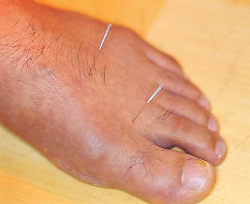 포토 JPG 신체 의학 발 실내 한명 근접촬영 아웃포커스 신체부위 치료 한의학 한의원 발가락 침술 수지침 국내포토 1 뷰포인트 촬영기법 병원 사람 내부 파일형식