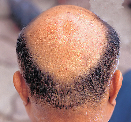 포토 JPG 할아버지 노년 신체 의학 병원 한명 사람 근접촬영 뒷모습 아웃포커스 신체부위 치료 머리카락 머리 피부 대머리 두상 두피 뒤통수 탈모 피부과 남자만 남자한명만 성인남자만 성인한명만 성인남자한명만 노인만 성인만 노인남자만 노인남자한명만 국내포토 1 헤어스타일 남자 뷰포인트 촬영기법 성인 증상 파일형식