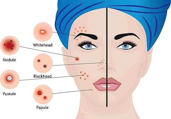 EPS 해외이미지 얼굴 일러스트 종류 한명 상반신 성인 뷰티 인포그래픽 정보 피부관리 여드름 피부병 성인여자한명만 해외202004 화이트헤드 블랙헤드 해외202105 해외일러스트 1 사람 신체부위 피부 피부질환 여자한명만 성인여자만 파일형식 벡터