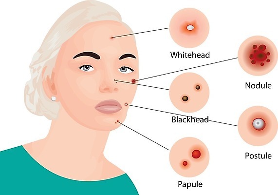 EPS 해외이미지 얼굴 일러스트 종류 한명 상반신 성인 뷰티 인포그래픽 정보 피부관리 여드름 피부질환 피부병 성인여자한명만 해외202004 화이트헤드 블랙헤드 해외202105 해외일러스트 1 사람 신체부위 질병 피부 여자한명만 성인여자만 파일형식 벡터