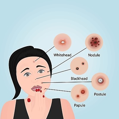 EPS 해외이미지 여자 얼굴 지도 신체 일러스트 표면 세포 건강 종류 사람 치료 빨간색 약 인포그래픽 피부 피부관리 흰배경 감염 문제 타입 박테리아 돌봄 효과 해외202004 해외일러스트 컬러 백그라운드 의학 모션 신체부위 뷰티 흰색 파일형식 벡터 이미지허브
