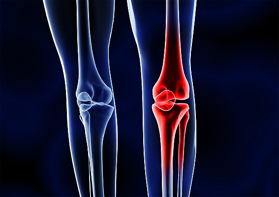 PSD 신체 해부 의학 투시 골격 엑스레이 건강 병원 사람없음 신체부위 그래픽 치료 3D소스 3D 다리 입체 관절염 관절 무릎 다리뼈 뼈 사람 질병 디지털합성 파일형식