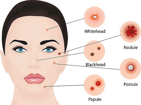 EPS 해외이미지 여자 지도 신체 일러스트 표면 종류 치료 인포그래픽 피부관리 흰배경 감염 문제 타입 여드름 염증 효과 해외202004 해외일러스트 백그라운드 의학 사람 뷰티 흰색 질병 파일형식 벡터 이미지허브
