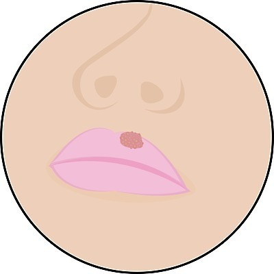 EPS 해외이미지 여자 얼굴 백그라운드 컨셉 일러스트 건강 사람 치료 약 고통 추위 흰색 열 입 조직 바이러스 질병 입술 감염 전염 문제 알레르기 고립 돌봄 염증 증상 해외202004 구내염 해외일러스트 감정 컬러 의학 모션 신체부위 파일형식 벡터 이미지허브