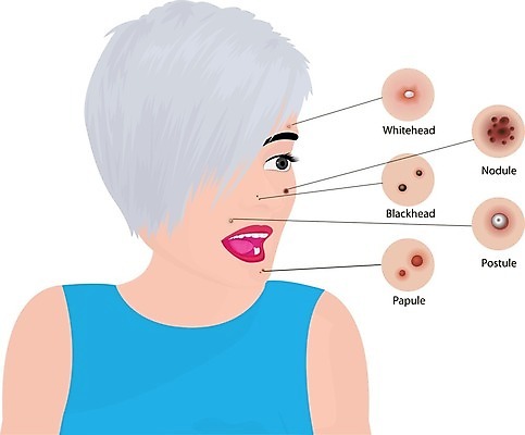 EPS 해외이미지 여자 얼굴 지도 신체 일러스트 표면 세포 건강 종류 사람 치료 빨간색 약 인포그래픽 피부 피부관리 흰배경 감염 문제 타입 박테리아 여드름 돌봄 염증 효과 해외202004 해외일러스트 컬러 백그라운드 의학 모션 신체부위 뷰티 흰색 질병 파일형식 벡터 이미지허브