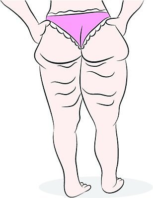 EPS 해외이미지 클립아트 여자 일러스트 미술 그래픽 화장품 속옷 몸무게 만화 비만 그림 클립 허벅지 넘어짐 흉터 셀룰라이트 해외202004 해외일러스트 옷 모션 문화예술 사람 신체부위 뷰티 상처 몸매 파일형식 벡터 이미지허브