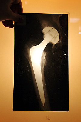 포토 JPG 해외이미지 신체 뼈 엑스레이 건강 병원 사람 사람없음 약 고통 환자 X 엉덩이 사건 허벅지 깨짐 방사선 보철 해외202004 해외포토 알파벳 감정 컨셉 의학 신체부위 파일형식 이미지허브