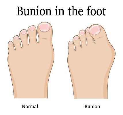 EPS 해외이미지 일러스트 해부 맨발 뼈 사람 약 고통 비교 플랫 질병 서식 문제 발가락 양발 왜곡 증상 해외202004 해외일러스트 감정 컨셉 의학 발 파일형식 벡터 이미지허브