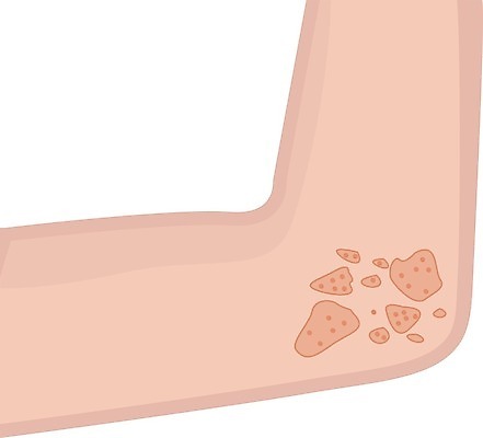 EPS 해외이미지 여자 백그라운드 일러스트 건강 사람 성인 빨간색 약 고통 환자 짜증 흰색 점 질병 피부 감염 문제 스킨케어 테라피 알레르기 고립 돌봄 염증 팔꿈치 해외202004 해외일러스트 감정 컬러 의학 모션 신체부위 뷰티 팔 파일형식 벡터 이미지허브