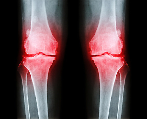 포토 JPG 해외이미지 해부 뼈 골격 엑스레이 성인 사람없음 빨간색 검은색 고통 환자 광선 흰색 질병 X 필름 관절염 무릎 골다공증 외과 허벅지 돌봄 방사선 연골 염증 옛날 정형외과 해외202004 해외포토 알파벳 감정 컬러 의학 모션 병원 사람 신체부위 파일형식 이미지허브