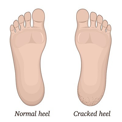 EPS 해외이미지 웰빙 일러스트 발 건강 사람 치료 약 놀람 고통 균열 질병 피부 문제 테라피 단절 불평 양발 치유 트러블 유일 해외202004 해외일러스트 감정 의학 모션 표정 신체부위 뷰티 파일형식 벡터 이미지허브