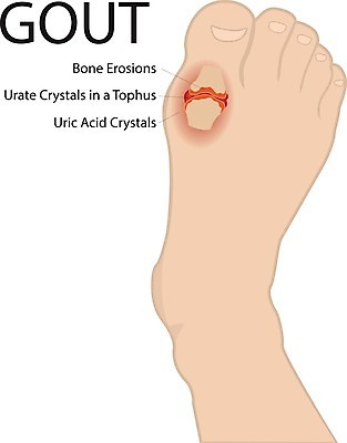 EPS 해외이미지 클립아트 길 과학 백그라운드 신체 일러스트 해부 뼈 건강 사람 약 고통 흰색 수술 오르간 질병 크리스탈 오브젝트 부식 그림 관절염 생물학 결정체 문제 발가락 신맛 양발 엘리먼트 염증 정형외과 해외202004 해외일러스트 교육 감정 컬러 의학 발 병원 치료 건반악기 맛 광석 파일형식 벡터 이미지허브