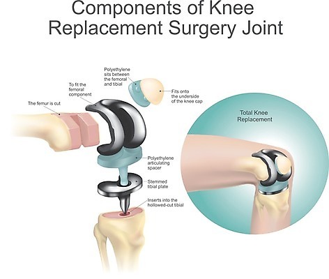 EPS 해외이미지 접시 일러스트 표면 근육 뼈 달리기 산책 고통 환자 조직 매끈함 자르기 무릎 외과 골절 교체 보철 스테인레스 압력 작동 해외202004 해외일러스트 식기 감정 의학 모션 휴식 병원 신체부위 감각 파일형식 벡터 이미지허브