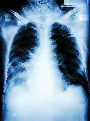 포토 JPG 해외이미지 백그라운드 신체 태국 엑스레이 건강 병원 사람 동양인 성인 사람없음 약 모니터 검은색 고통 환자 간호사 의사 광선 흰색 하트 호흡기관 질병 X 흉부 필름 감염 튜브 궤 돌봄 심각 해외202004 해외포토 모양 알파벳 감정 아시아 컬러 컨셉 의학 모션 인종 컴퓨터 의료진 장기_의학 파일형식 이미지허브