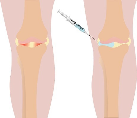 EPS 해외이미지 직업 과학 컨셉 신체 일러스트 해부 건강 병원 주사기 사람 내부 치료 약 산책 손상 고통 환자 의사 기구 긴급 대접 수술 질병 상처 몸무게 위험 하락 사건 무릎 문제 주사약 무거움 외과 테라피 순서 돌봄 연골 염증 정형외과 증상 헬프 해외202004 해외일러스트 감정 의학 의료기기 모션 휴식 신체부위 뷰티 의료진 도움 무게 파일형식 벡터 이미지허브