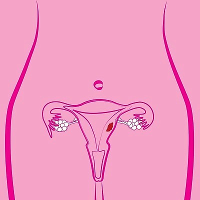 EPS 해외이미지 여자 과학 일러스트 해부 건강 사람 내부 약 임신 오르간 질병 척추 그림 시스템 문제 섬유 자궁 암 타입 종양 해외202004 해외일러스트 의학 뼈 직물 장기_의학 건반악기 파일형식 벡터 이미지허브