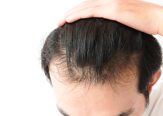 포토 JPG 해외이미지 남자 한명 상반신 성인 뷰티 머리카락 머리 흰배경 두피관리 두피케어 탈모 탈모클리닉 성인남자한명만 해외202004 탈모예방 해외포토 1 백그라운드 사람 신체부위 흰색 예방 클리닉 헤어관리 증상 남자한명만 성인남자만 파일형식 이미지허브