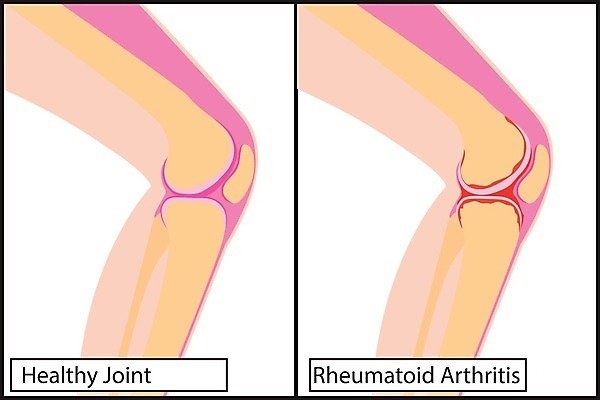EPS 해외이미지 과학 신체 일러스트 손가락 해부 근육 뼈 골격 건강 종류 사람 약 고통 거친 질병 관절염 무릎 골다공증 테라피 타입 돌봄 면역력 연골 염증 지원 해외202004 해외일러스트 손 감정 의학 모션 신체부위 뷰티 파일형식 벡터 이미지허브
