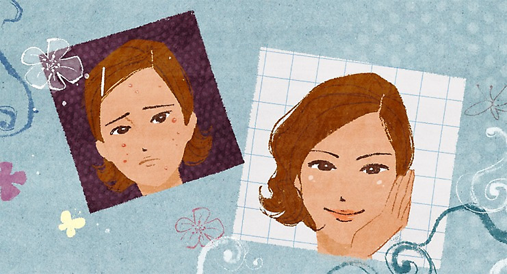 PSD 식물 우먼라이프 라이프스타일 여자 꽃 일러스트 새로움 사람 성인 두명 라이프 신체부위 뷰티 광선 비교 변화 성형수술 피부 시술 여드름 기념사진 전후 여자만 성인여자만 성인만 국내일러스트 컨셉 생활 수술 파일형식