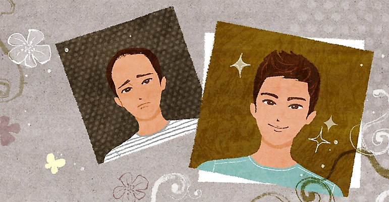 PSD 식물 우먼라이프 라이프스타일 남자 꽃 일러스트 새로움 사람 상반신 성인 두명 라이프 신체부위 뷰티 비교 변화 성형수술 기념사진 모발이식 탈모 전후 남자만 성인남자만 성인만 그루밍족 국내일러스트 컨셉 생활 수술 증상 파일형식