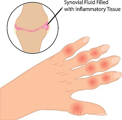 EPS 해외이미지 손 과학 신체 일러스트 손가락 해부 근육 뼈 골격 건강 사람 약 고통 거친 조직 질병 관절염 테라피 타입 돌봄 면역력 연골 염증 지원 해외202004 해외일러스트 감정 의학 모션 신체부위 뷰티 파일형식 벡터 이미지허브