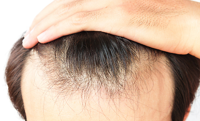 포토 JPG 해외이미지 남자 한명 상반신 성인 뷰티 머리카락 머리 흰배경 두피관리 두피케어 탈모 탈모클리닉 성인남자한명만 해외202004 탈모예방 해외포토 1 백그라운드 사람 신체부위 흰색 예방 클리닉 헤어관리 증상 남자한명만 성인남자만 파일형식 이미지허브