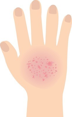 EPS 해외이미지 손 백그라운드 일러스트 건조 건강 사람 빨간색 약 고통 환자 짜증 흰색 점 질병 피부 감염 문제 스킨케어 팔 테라피 알레르기 두드러기 고립 돌봄 염증 해외202004 해외일러스트 감정 컬러 의학 모션 신체부위 뷰티 파일형식 벡터 이미지허브