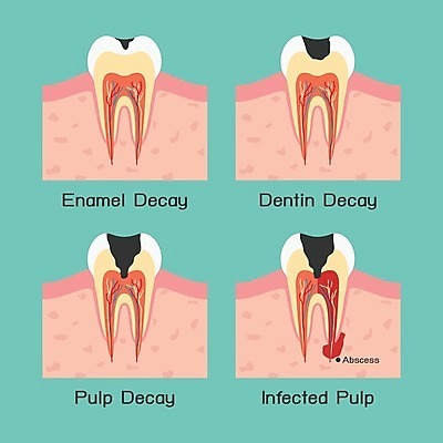 EPS 해외이미지 디자인 교육 과학 일러스트 해부 왕관 건강 치과 미술 치료 약 인포그래픽 고통 입 구멍 오르간 치아 질병 치과의사 함선 감염 뿌리 문제 박테리아 단계 정맥 돌봄 명패 방법 썩음 염증 위생관리 잇몸 치통 미니멀 해외202004 해외일러스트 감정 신체 배_교통 의학 모션 문화예술 병원 관리 신체부위 의사 소화기관 건반악기 혈관 파일형식 벡터 이미지허브